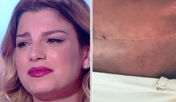 emma marrone tumore ovaie cicatrice