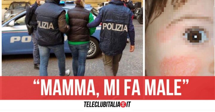 milano spray su corpo bambina ricovero